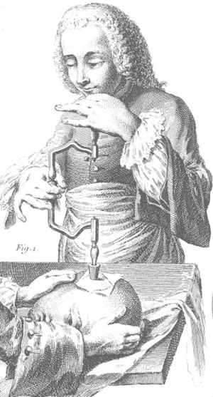18th century French illustration of trepanation
