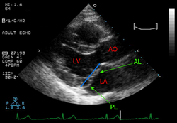 Transthoracic echocardiogram showing prolapse of both leaflets of the mitral valve