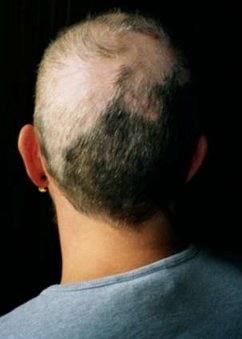 Trichotillomania in a young woman
