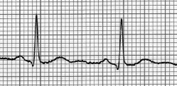 ECG trace