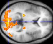 Brain activation from fMRI shown as patch of colour on MRI scan