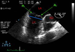Transesophagel echocardiogram showing prolapse of both leaflets of the mitral valve
